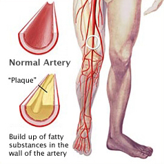 Diabetes & Peripheral Vascular Disease: The Special Connection