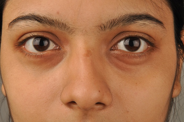 Puffy Eyes – Causes & Natural Home Remedies For Swollen Eyes